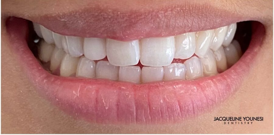 After treatment: the completed single crown repair result, photographed at Jacqueline Younesi Dentistry.