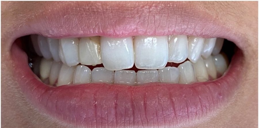 Before treatment: the same teeth prior to single crown repair, photographed at Jacqueline Younesi Dentistry.