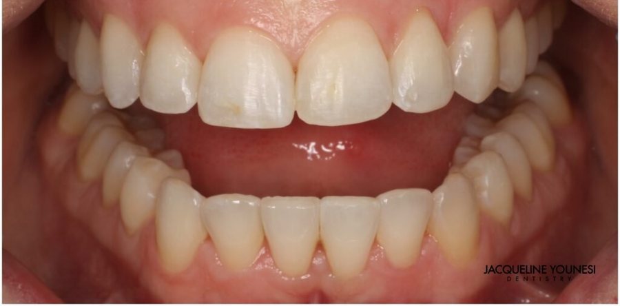 After treatment: the completed invisalign clear aligners result, photographed at Jacqueline Younesi Dentistry.