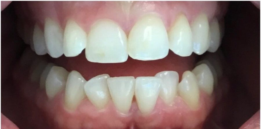 Before treatment: the same teeth prior to invisalign clear aligners, photographed at Jacqueline Younesi Dentistry.