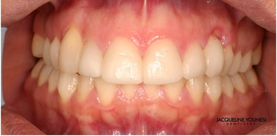 After treatment: the completed porcelain veneers result, photographed at Jacqueline Younesi Dentistry.