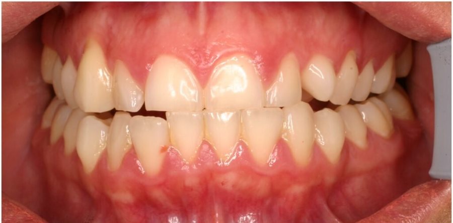 Before treatment: the same teeth prior to porcelain veneers, photographed at Jacqueline Younesi Dentistry.