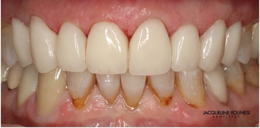 After treatment: the completed porcelain veneers and crowns result, photographed at Jacqueline Younesi Dentistry.