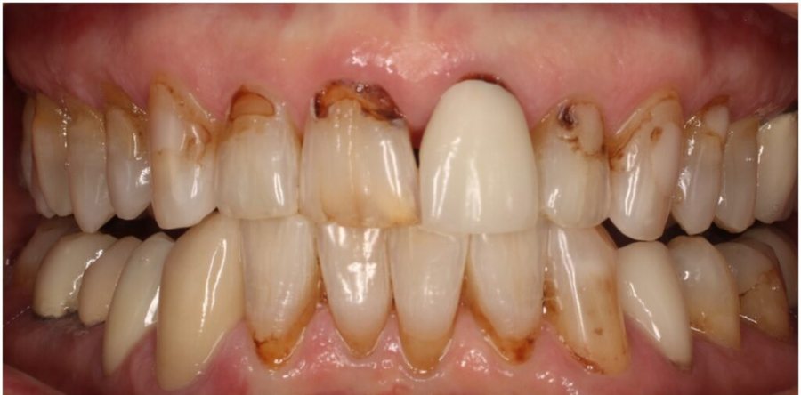 Before treatment: the same teeth prior to porcelain veneers and crowns, photographed at Jacqueline Younesi Dentistry.