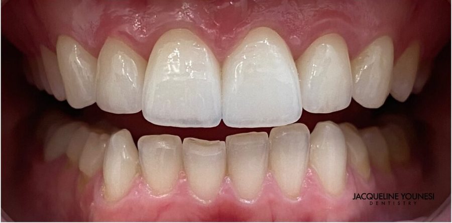 After treatment: the completed full upper redesign result, photographed at Jacqueline Younesi Dentistry.