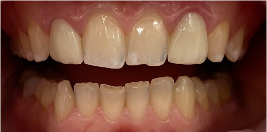 Before treatment: the same teeth prior to full upper redesign, photographed at Jacqueline Younesi Dentistry.