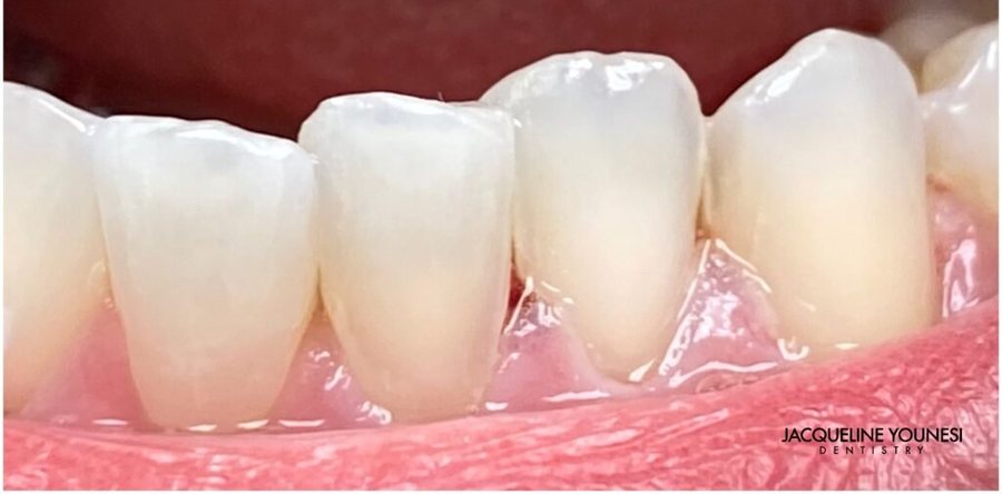 After treatment: the completed ICON resin infiltration result, photographed at Jacqueline Younesi Dentistry.