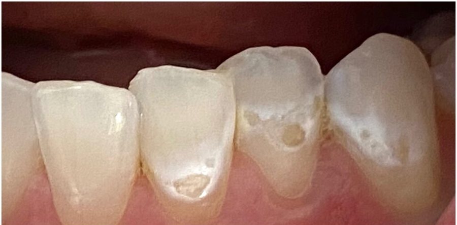Before treatment: the same teeth prior to ICON resin infiltration, photographed at Jacqueline Younesi Dentistry.